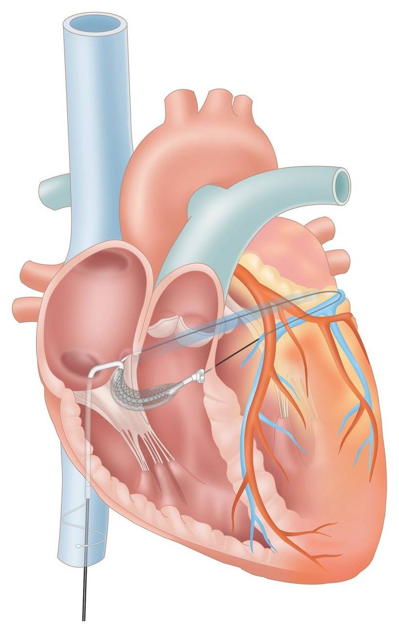 MTR Combo implanted, four-chamber view
