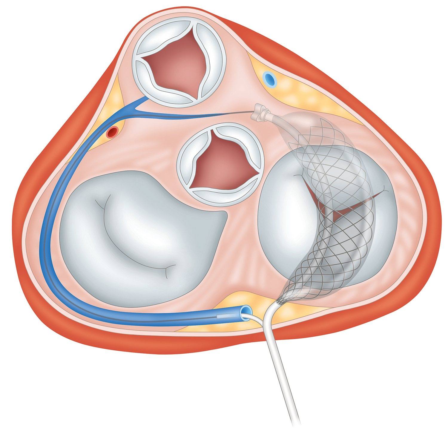 MTR Combo implanted, short-axis view